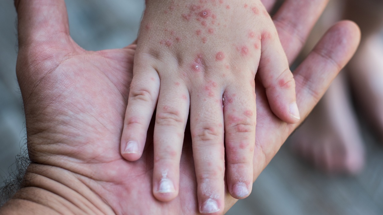 Incremento de casos de virus Coxsackie en Perú: prevención y cuidados –