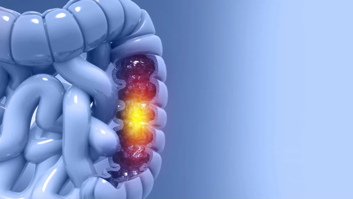 Cáncer de colon: señales de alerta que no deben ignorarse
