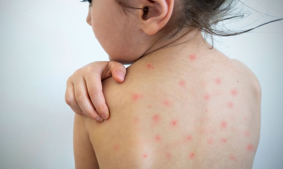 Gerencia Regional de Salud confirma 293 casos de sarampión y refuerza vigilancia epidemiológica –